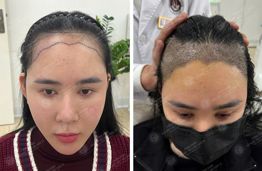  Nguyễn Tuyết Lan - Cấy tóc tự thân 1