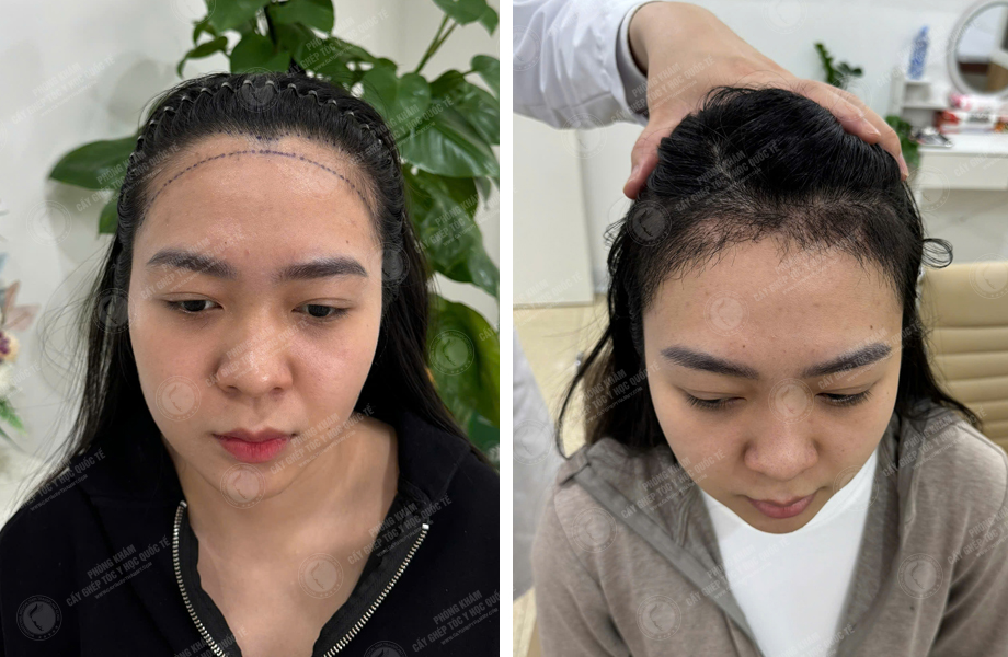  Nguyễn Hồng Hạnh - Cấy tóc đường chữ M 1