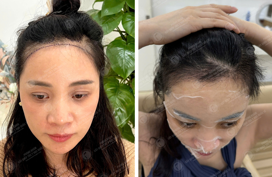  Lê Ánh Nguyệt - Cấy tóc đường chữ M 1