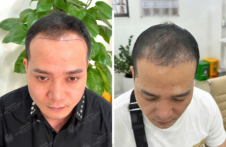 Trần Quốc Hoàn - Cấy tóc tự thân 1