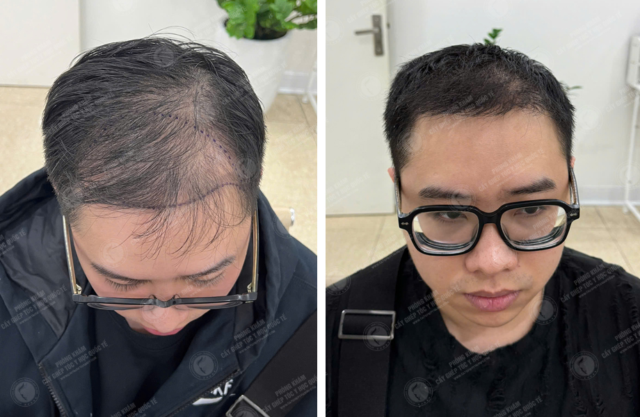  Bùi Văn Nguyên - Cấy tóc tự thân 1