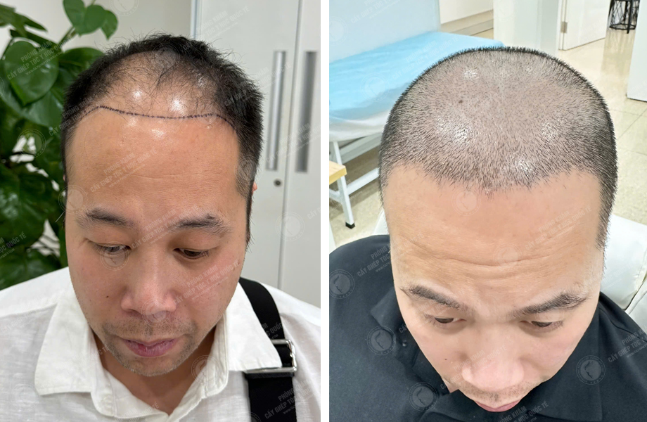  Nguyễn Hữu Cường - Cấy tóc tự thân 1