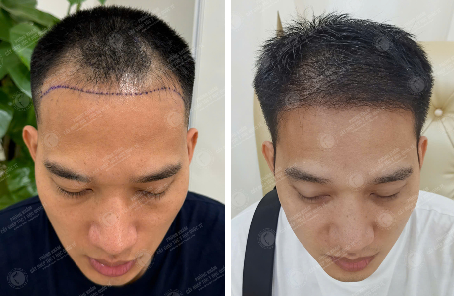  Lê Thanh Sơn - Cấy tóc tự thân 1