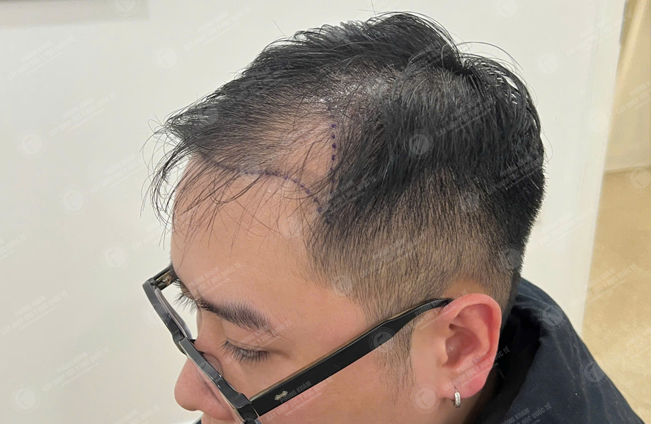 Bùi Văn Nguyên - Cấy tóc đường chữ M 3