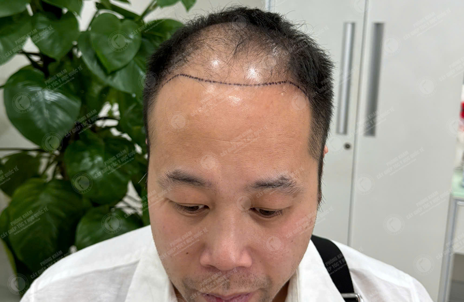 Nguyễn Hữu Cường - Cấy tóc đường chữ M 3