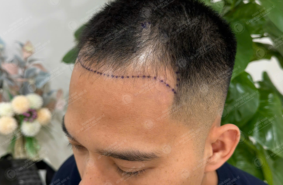 Lê Thanh Sơn - Cấy tóc đường chữ M 3
