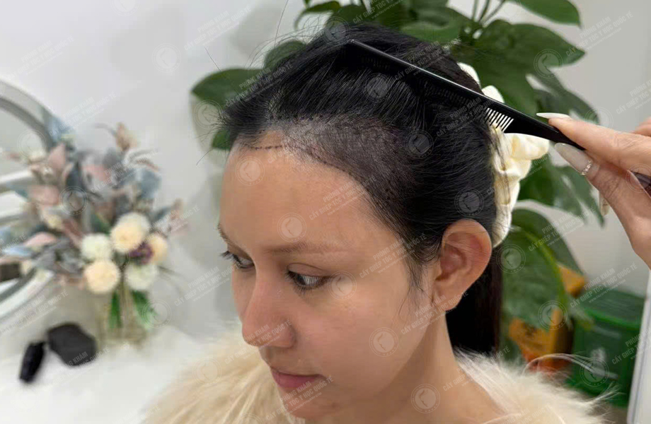 Trần Thị Huyền - Cấy tóc đường chữ M 3
