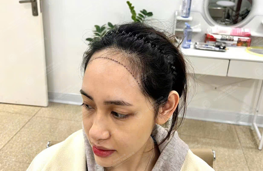 Trần Thị Hồng - Cấy tóc đường chữ M 3