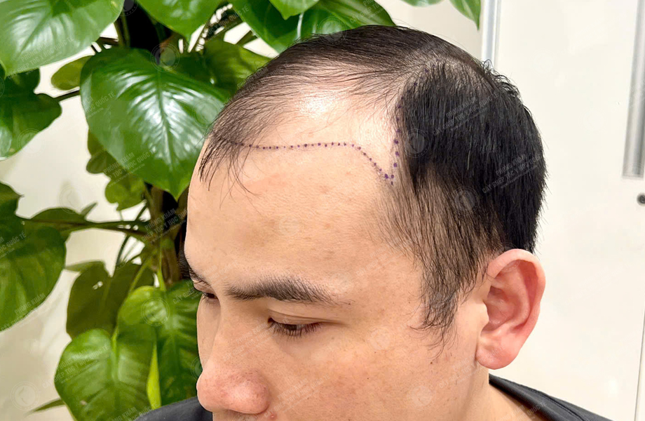 Hoàng Sơn Trung - Cấy tóc đường chữ M 3