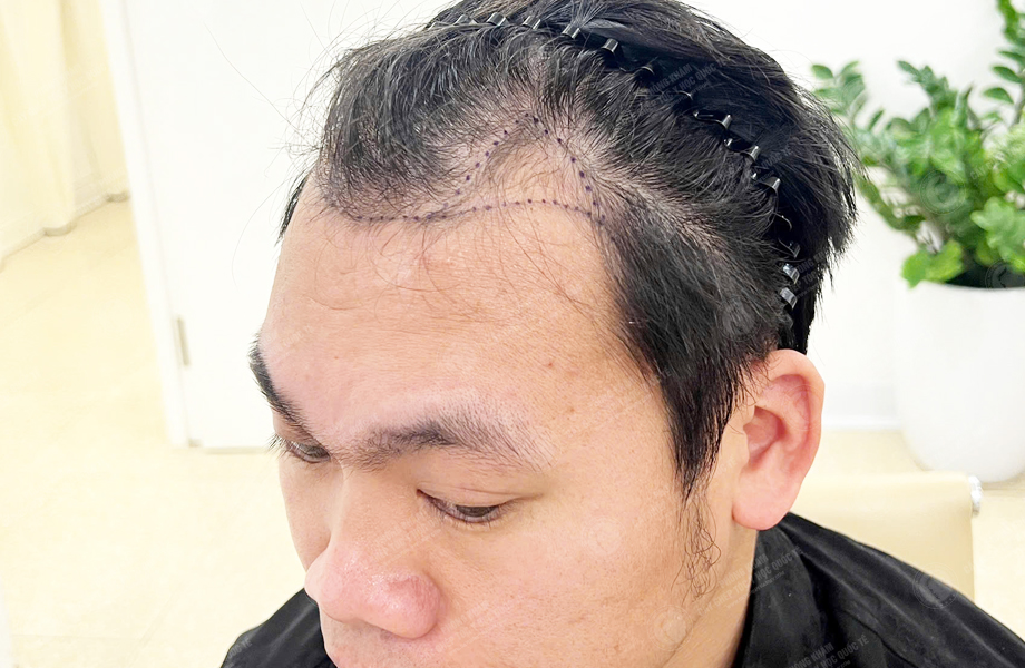 Trần Quốc Sơn - Cấy tóc đường chữ M 3