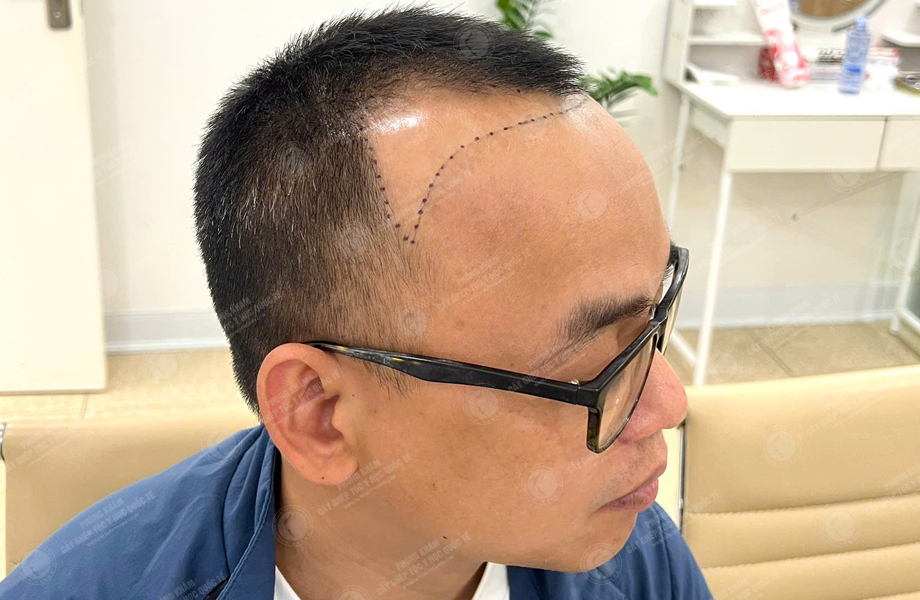 Lê Thanh Tùng - Cấy tóc đường chữ M 3