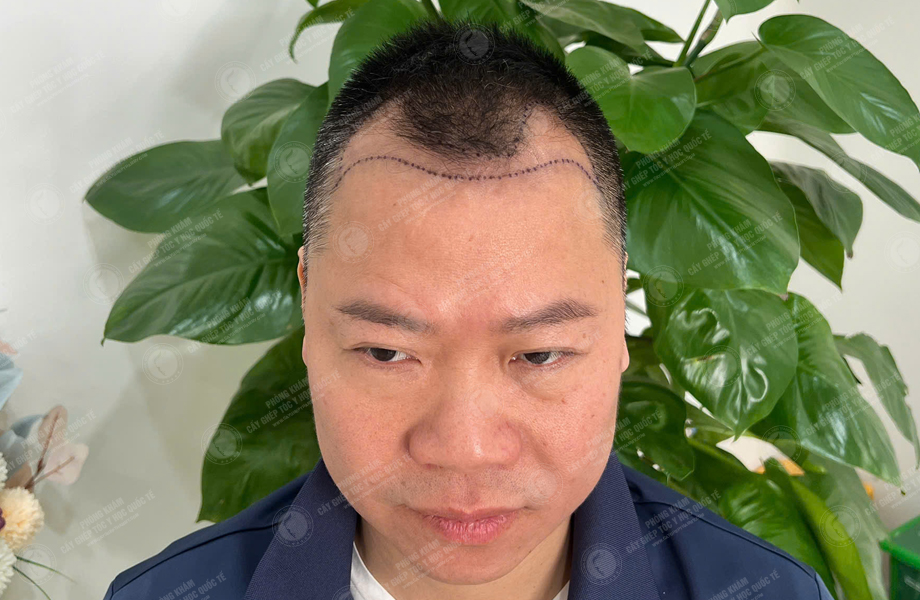 Phùng Thế Lữ - Cấy tóc đường chữ M 3
