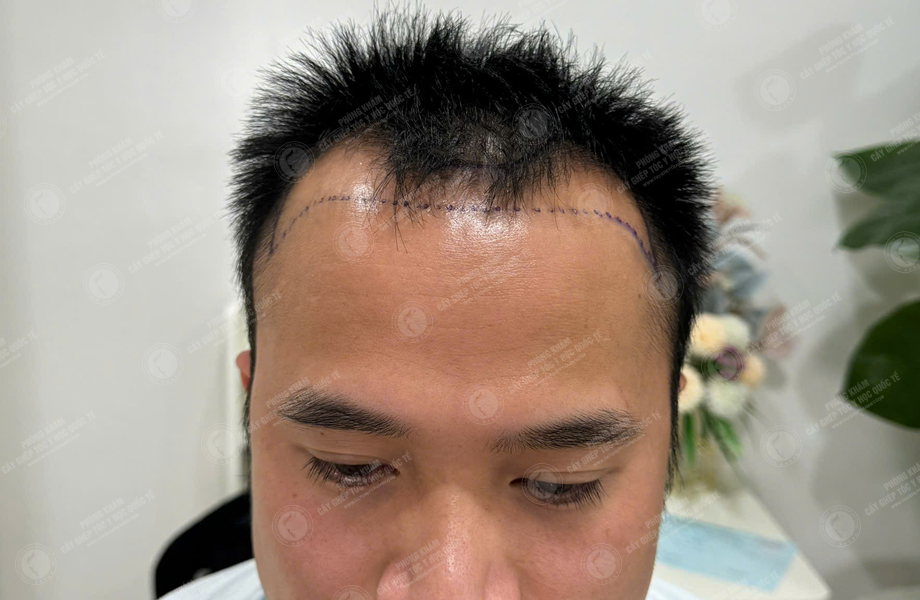 Nguyễn Tuấn Sơn - Cấy tóc đường chữ M 3