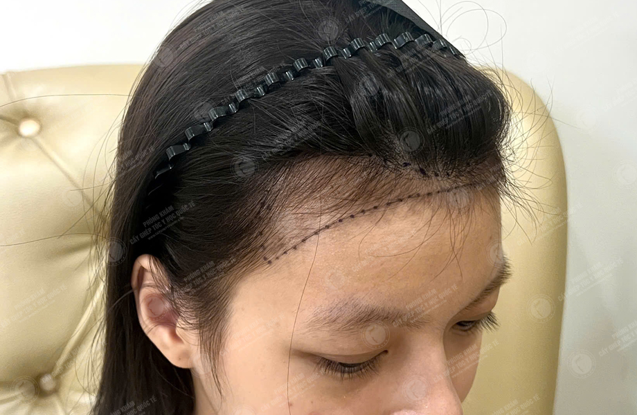 Lê Ngọc Linh - Cấy tóc đường chữ M 3
