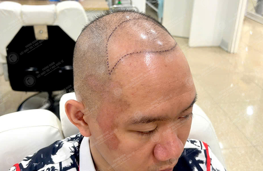 Trần Minh Linh - Cấy tóc đường chữ M 3
