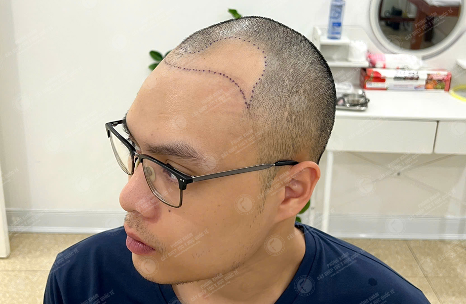 Nguyễn Thành Sơn - Cấy tóc đường chữ M 3