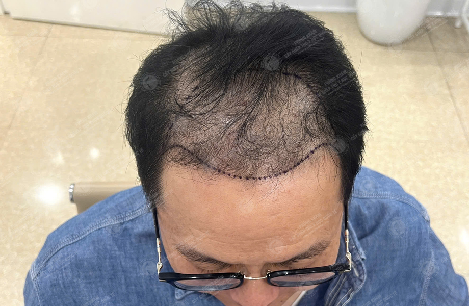 Lê Quý Sang - Cấy tóc đường chữ M 4