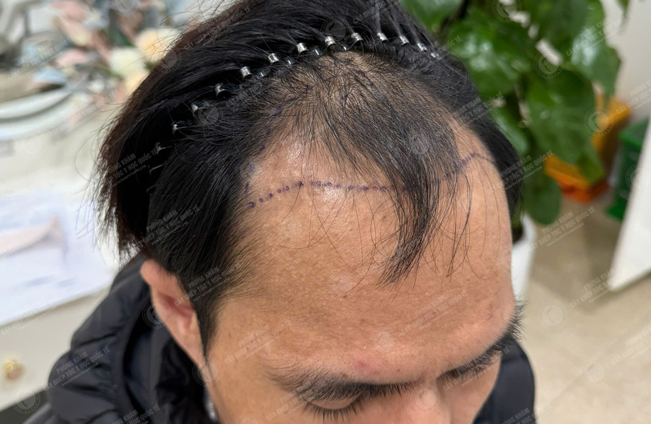 Nguyễn Đức Tâm - Cấy tóc đường chữ M 3