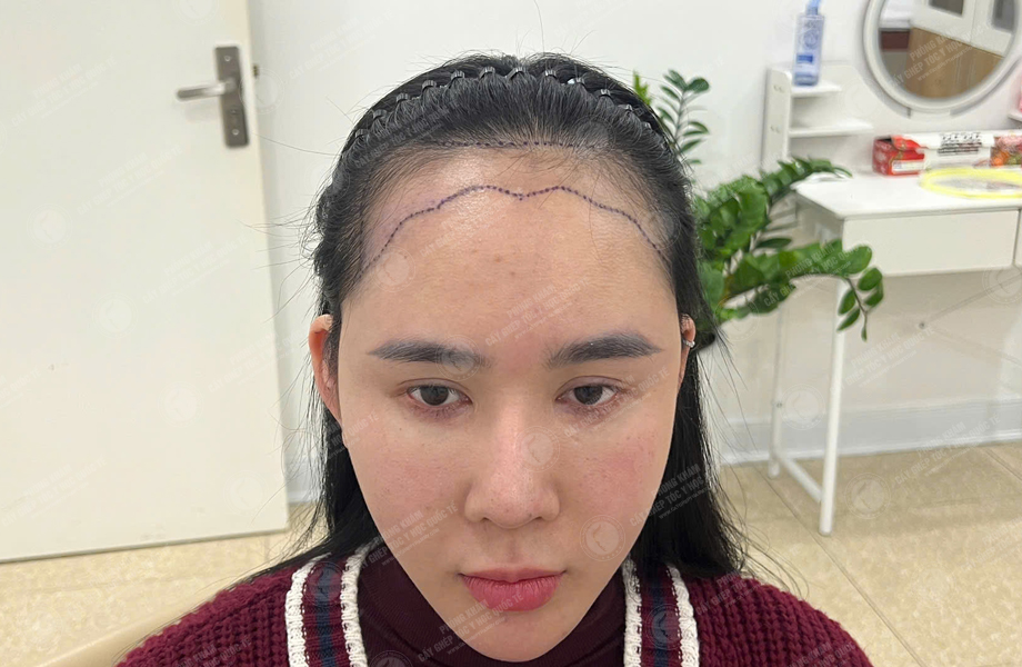 Nguyễn Tuyết Lan - Cấy tóc đường chữ M 3