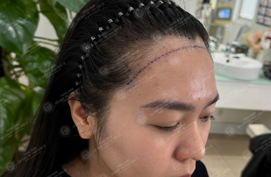Nguyễn Hồng Hạnh - Cấy tóc đường chữ M 3