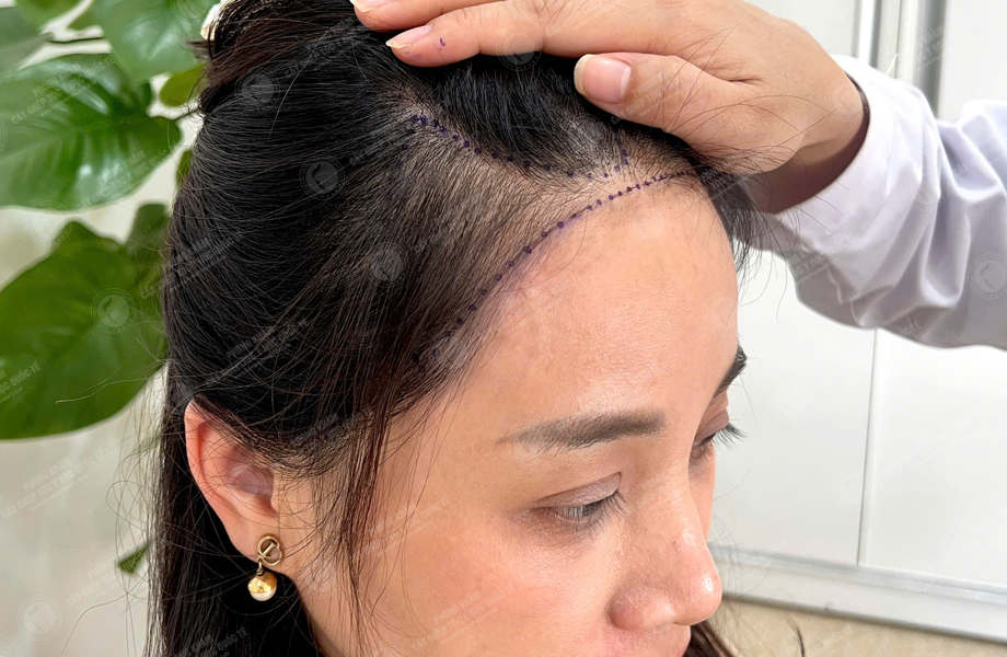 Lê Ánh Nguyệt - Cấy tóc đường chữ M 3