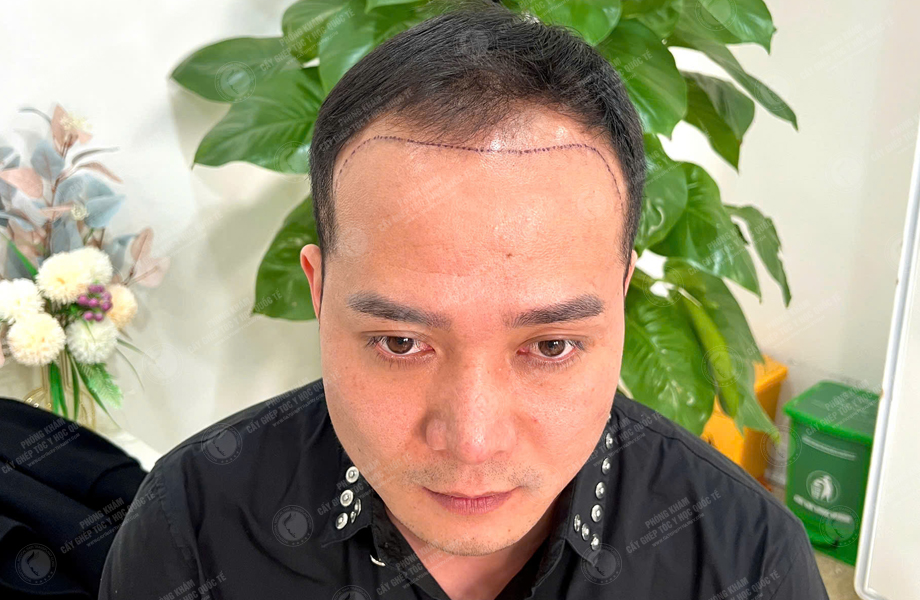 Trần Quốc Hoàn - Cấy tóc đường chữ M 3
