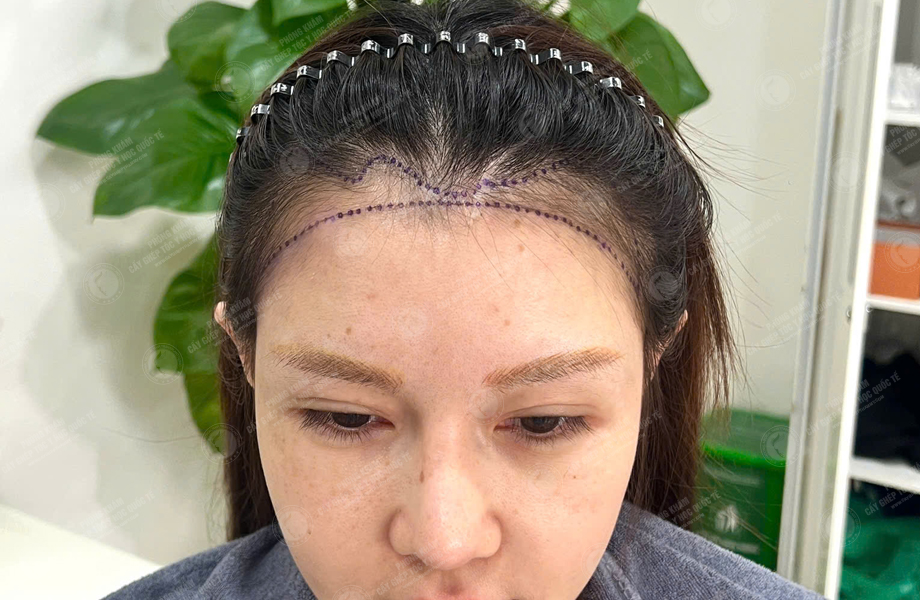 Nguyễn Mai Hoa - Cấy tóc đường chữ M 3