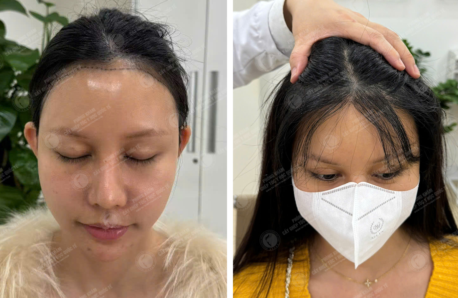  Trần Thị Huyền - Cấy tóc tự thân 1