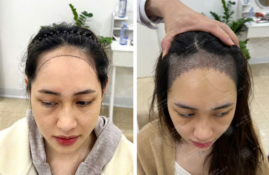  Trần Thị Hồng - Cấy tóc đường chữ M 1