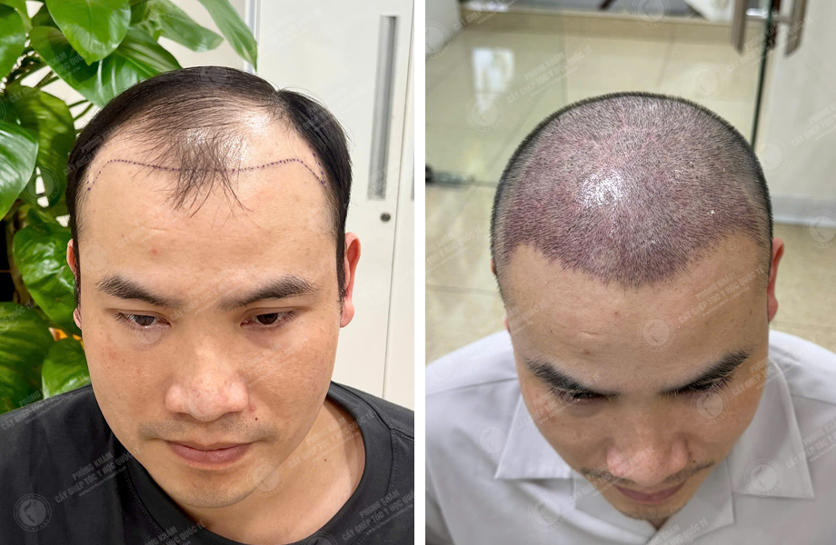  Hoàng Sơn Trung - Cấy tóc tự thân 1