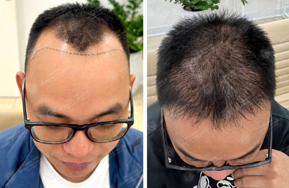  Lê Thanh Tùng - Cấy tóc tự thân 1