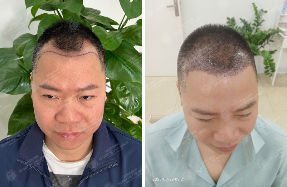  Phùng Thế Lữ - Cấy tóc tự thân 1
