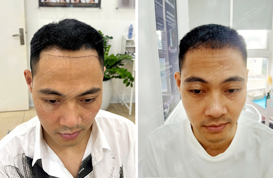  Trần Văn Nhất - Cấy tóc đường chữ M 1