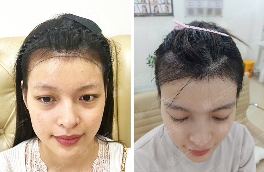  Lê Ngọc Linh - Cấy tóc đường chữ M 1