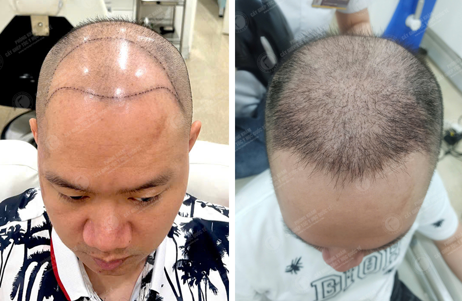  Trần Minh Linh - Cấy tóc đường chữ M 1