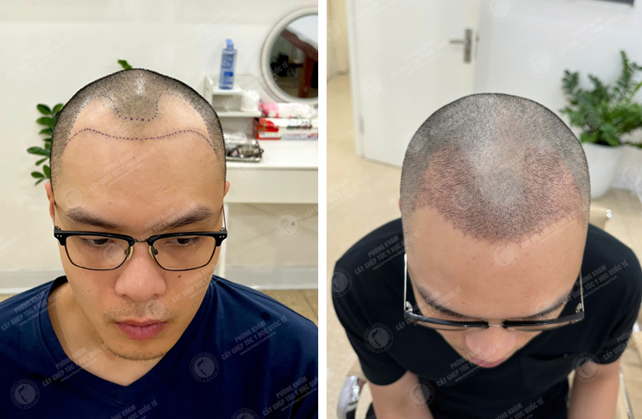  Nguyễn Thành Sơn - Cấy tóc đường chữ M 1