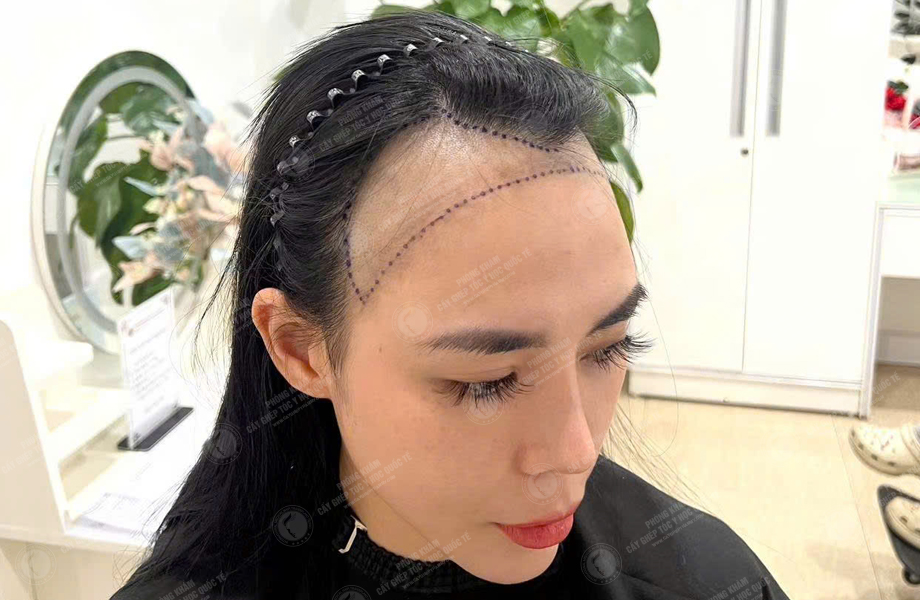 Nguyễn Tuyết Mai - Cấy tóc đường chữ M 4
