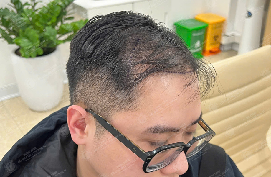 Bùi Văn Nguyên - Cấy tóc đường chữ M 4