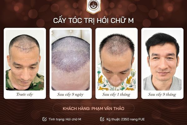 Thời gian phục hồi sau cấy tóc mất bao lâu? Giải đáp chi tiết từ A–Z