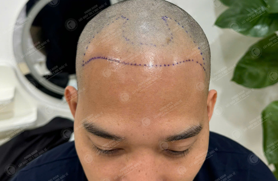 Lê Thanh Sơn - Cấy tóc đường chữ M 4
