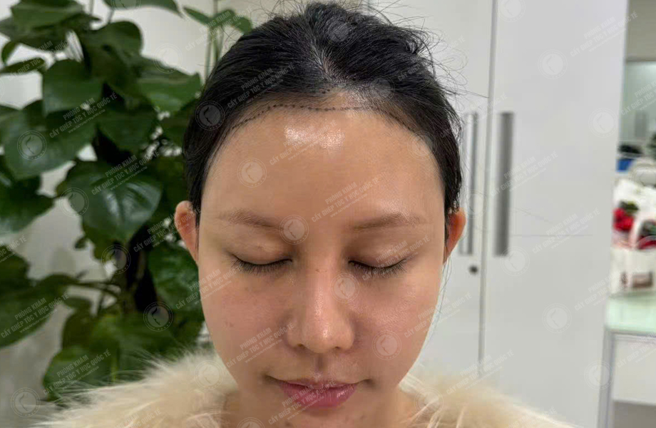 Trần Thị Huyền - Cấy tóc đường chữ M 4