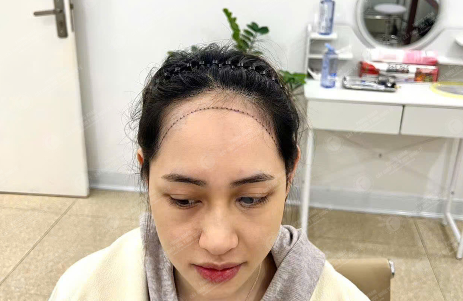Trần Thị Hồng - Cấy tóc đường chữ M 4