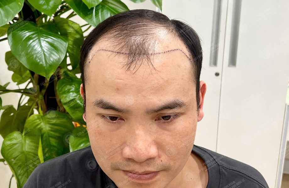 Hoàng Sơn Trung - Cấy tóc đường chữ M 4