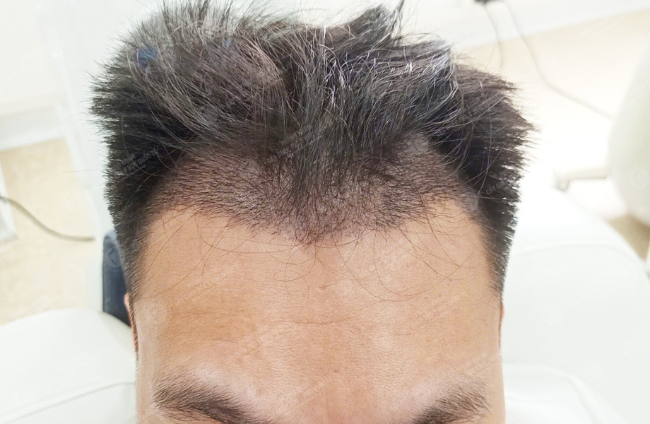 Trần Quốc Sơn - Cấy tóc đường chữ M 4