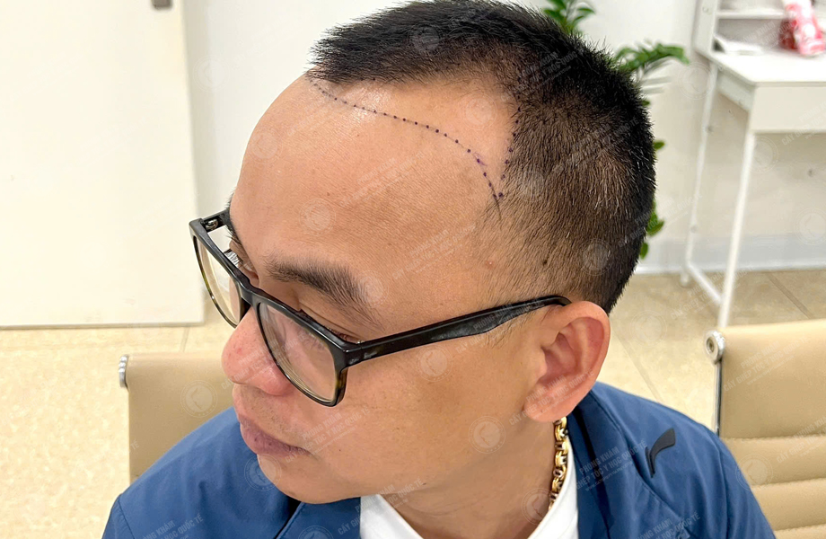 Lê Thanh Tùng - Cấy tóc đường chữ M 4