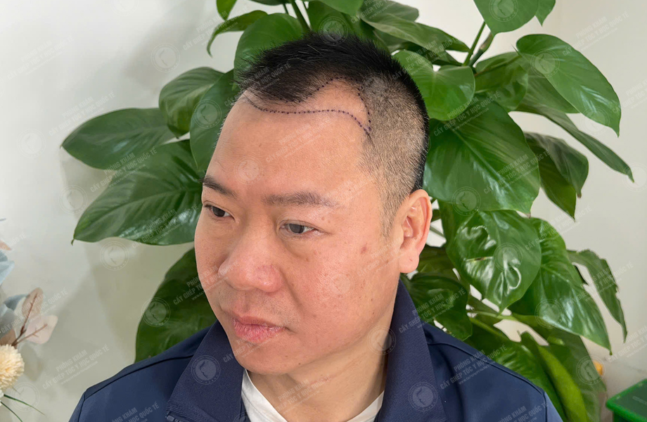Phùng Thế Lữ - Cấy tóc đường chữ M 4
