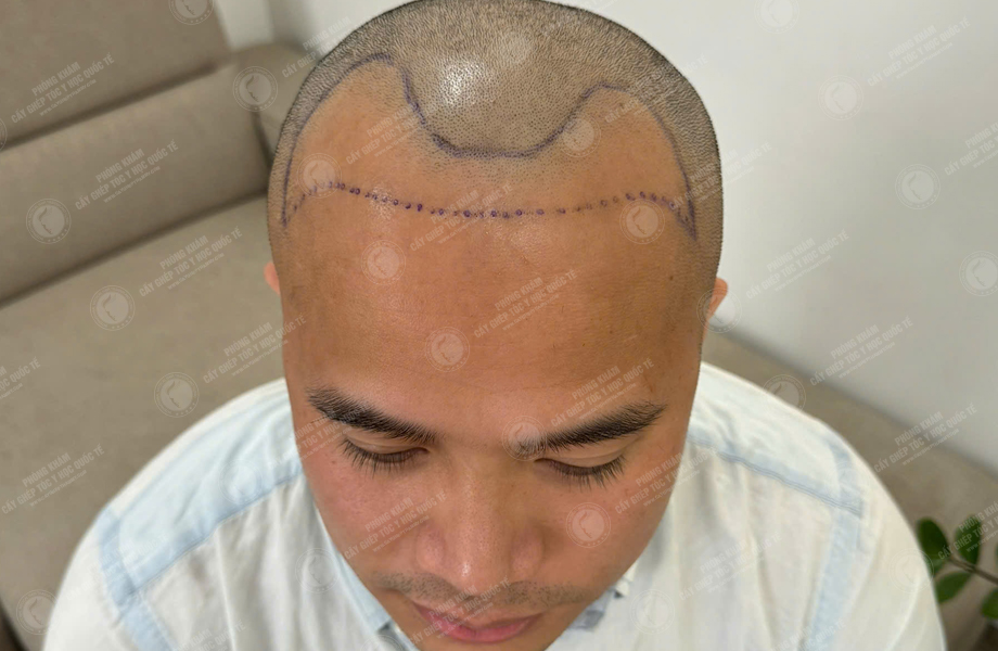 Nguyễn Tuấn Sơn - Cấy tóc đường chữ M 4
