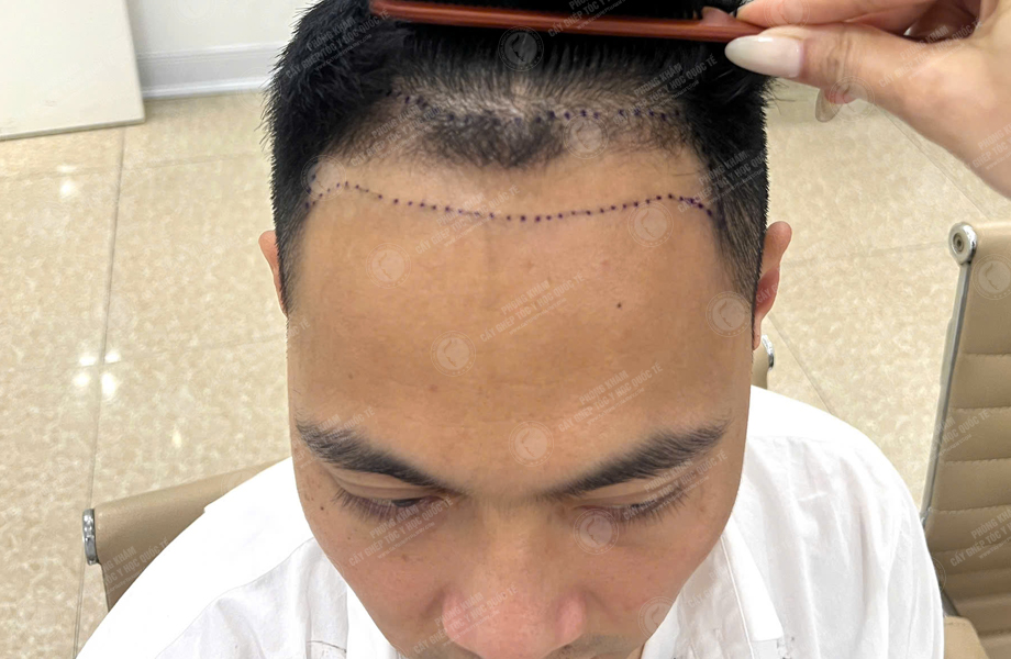 Trần Văn Nhất - Cấy tóc đường chữ M 4