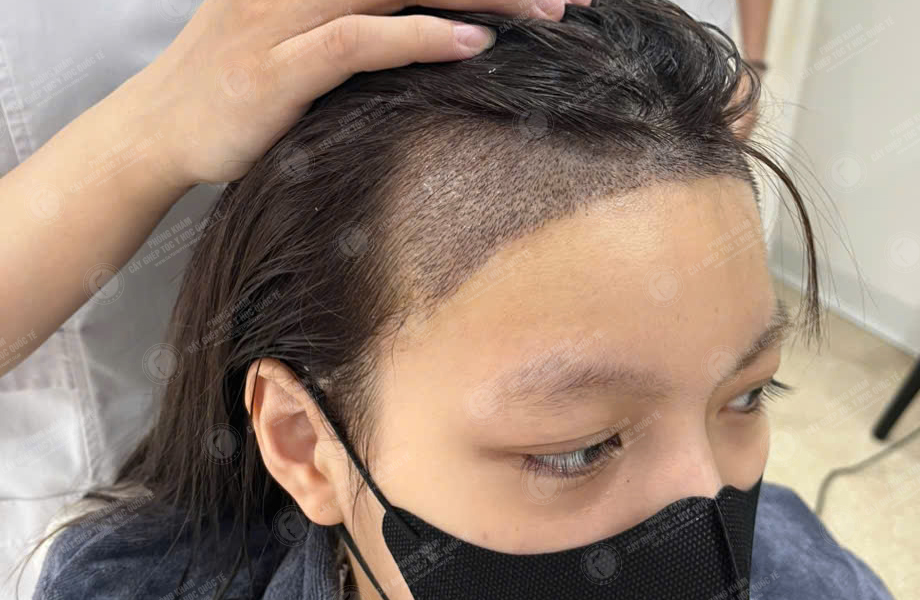 Lê Ngọc Linh - Cấy tóc đường chữ M 4