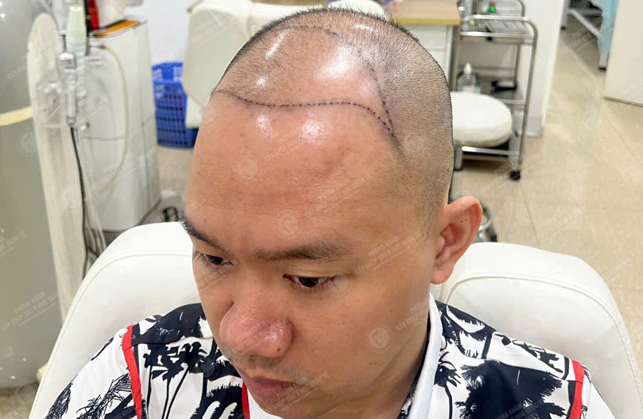 Trần Minh Linh - Cấy tóc đường chữ M 4